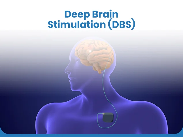 Deep Brain Stimulation Surgery Hospital – DBS Cost